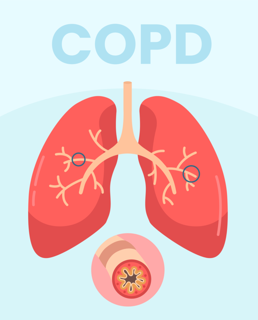 COPD- A Prevailing Disease in India - MegaMed India